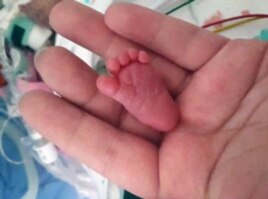 FILE: Baby Emilia's foot measured 3.1 centimetres in the birth. The baby was born in Germany and said to be the smallest ever born in the world who survived a premature birth.