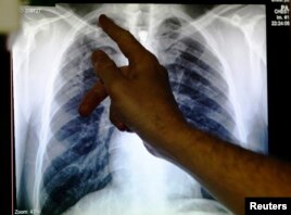 A doctor points to an x-ray showing a pair of lungs infected with TB (tuberculosis) in Ladbroke Grove in London, England, Jan. 27, 2014.