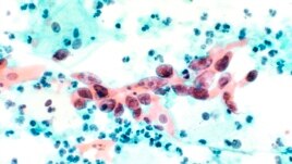 Traditional Test for Cervix Cancer Being Used to Test for Other Cancers