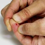 When a Cut Finger Is More Serious Than It Might Seem